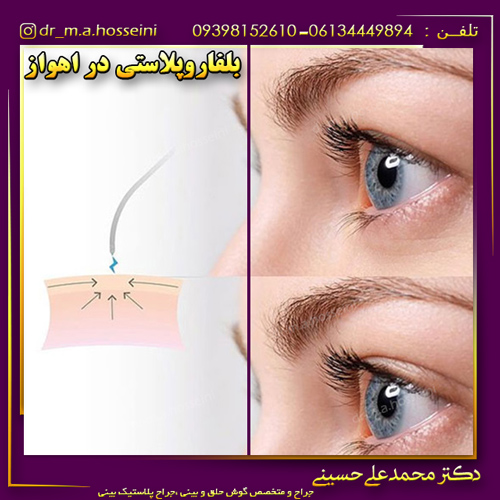 بلفاروپلاستی-در-اهواز