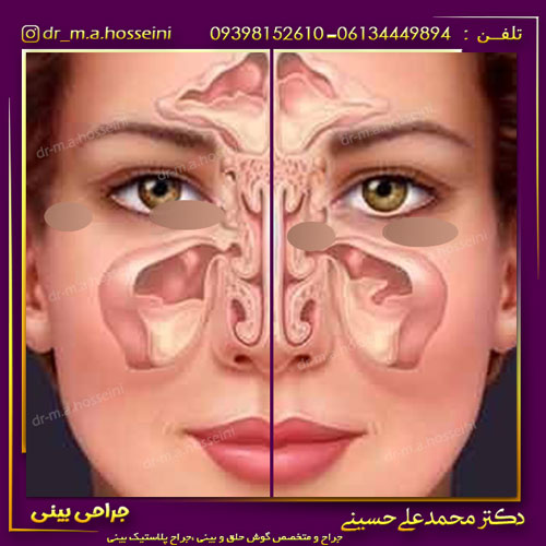 جراحی انحراف بینی