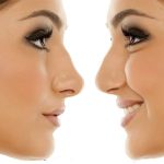 شاخص تفاوت بین جراحی بینی گوشتی و استخوانی