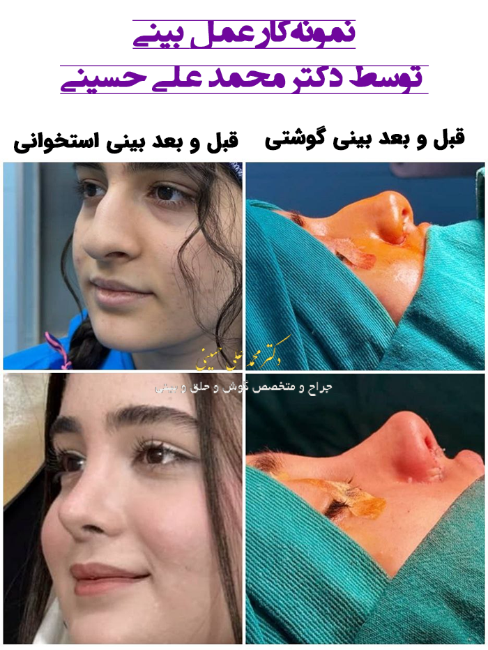 تفاوت جراحی بینی گوشتی با استخوانی
