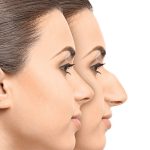 شاخص جراحی بینی استخوانی