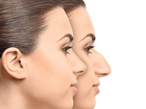 شاخص جراحی بینی استخوانی
