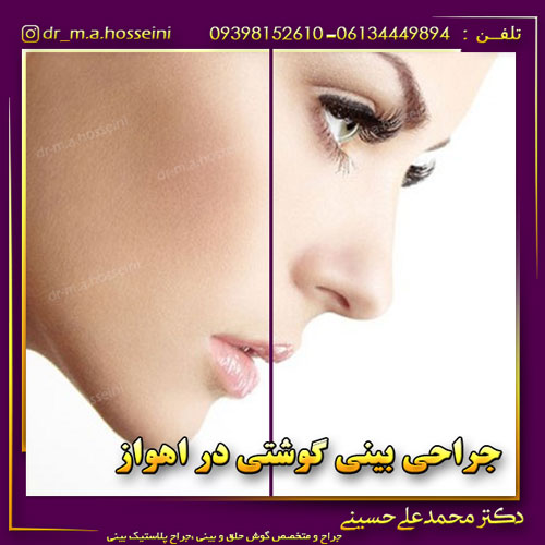 جراحی بینی گوشتی در اهواز