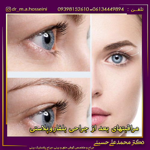 مراقبتهای بعد از جراحی بلفاروپلاستی