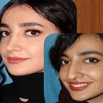 قبل و بعد جراحی بینی فانتزی در اهواز
