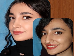 قبل و بعد جراحی بینی فانتزی در اهواز