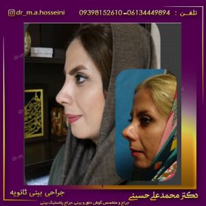 جراحی بینی ثانویه در اهواز