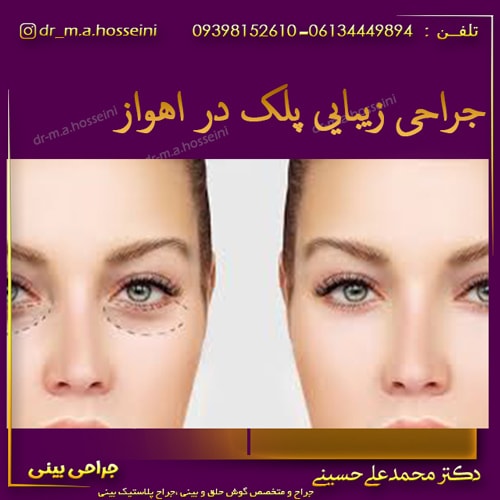 جراحی بینی طبیعی در اهواز