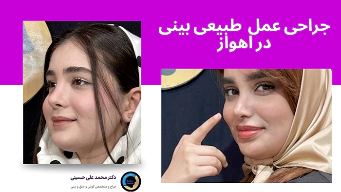 جراحی عمل بینی طبیعی در اهواز