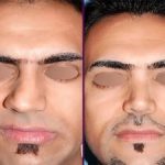 نمونه واقعی جراحی بینی طبیعی مردانه در اهواز
