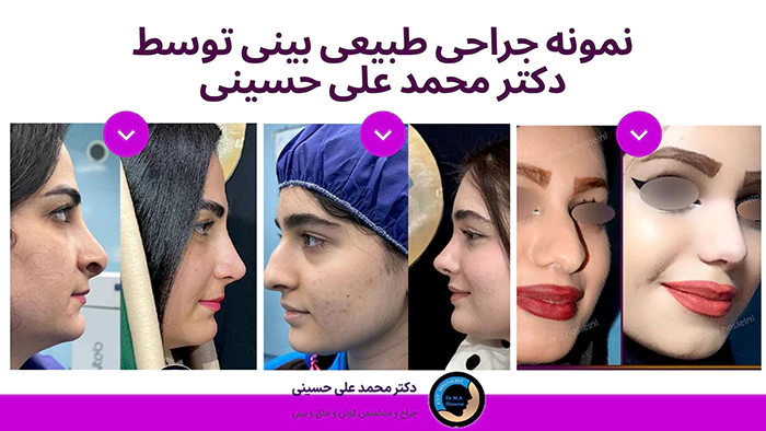 عکس عمل بینی طبیعی