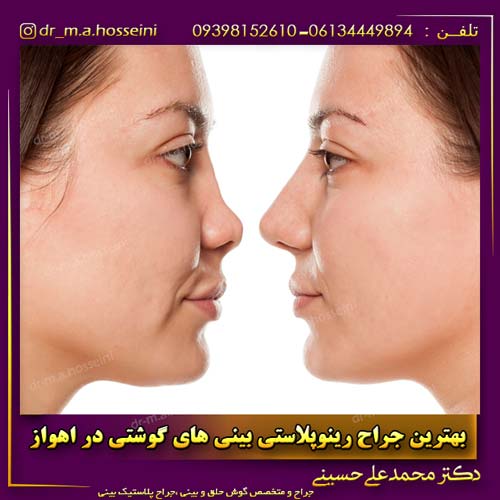 بهترین جراح رینوپلاستی بینی های گوشتی در اهواز