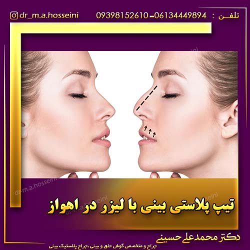 تیپ پلاستی بینی با لیزر در اهواز