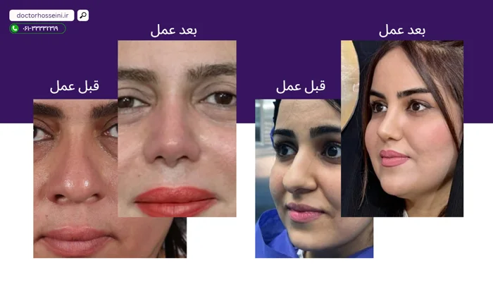 نمونه عمل بینی گوشتی توسط دکتر محمدعلی حسینی