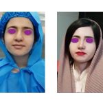 نمونه جراحی بینی کج