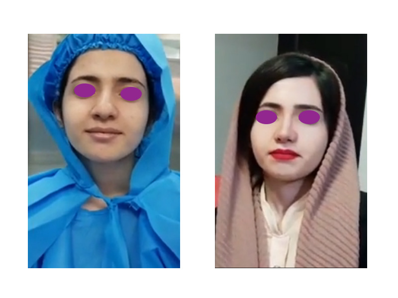 نمونه جراحی بینی کج