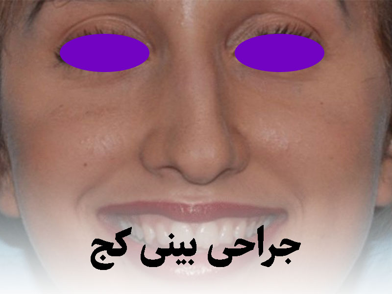 عمل بینی کج