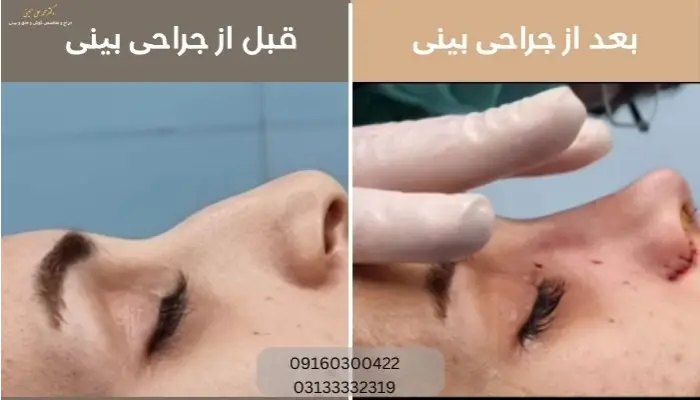نمونه جراحی بینی در اهواز