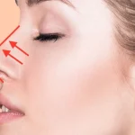 عمل بزرگ کردن بینی در اهواز