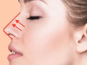 عمل بزرگ کردن بینی در اهواز