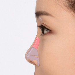حالت اول جراحی بینی کوتاه