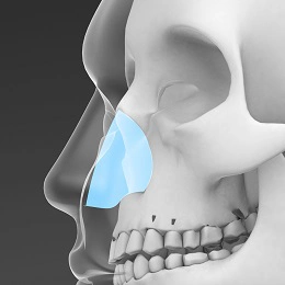 پیوند غضروف تیغه بینی در جراحی بینی کوتاه