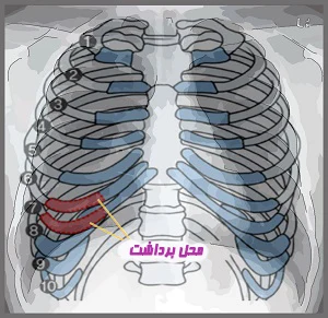 پیوند غضروف دنده