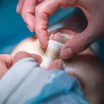 پیوند غضروف دنده در جراحی بینی
