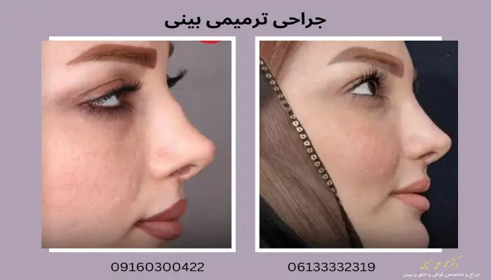 نمونه جراحی بینی ترمیمی
