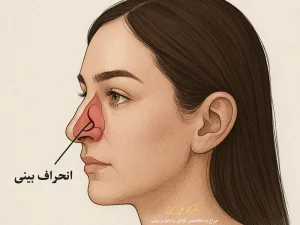 نمایش انحراف بینی در نیمرخ صورت