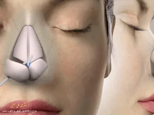با جراحی بینی چه مشکلاتی را می‌توانیم برطرف کنیم