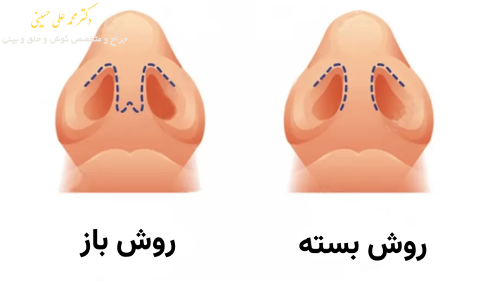 مقایسه عمل بینی باز و بسته
