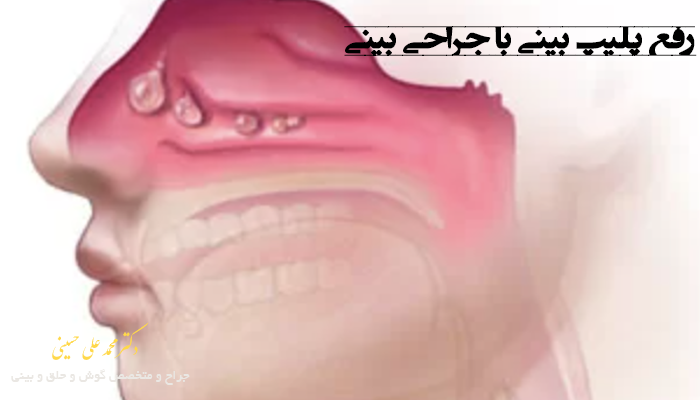 رفع پلیپ بینی بعد از عمل بینی