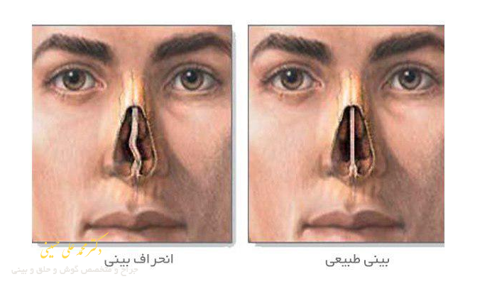 مقایسه بینی طبیعی و انحراف بینی