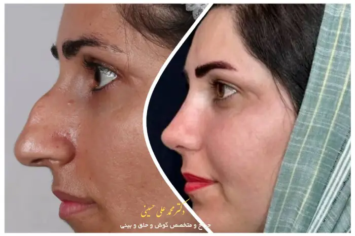 عکس عمل بینی توسط دکتر محمد علی حسینی