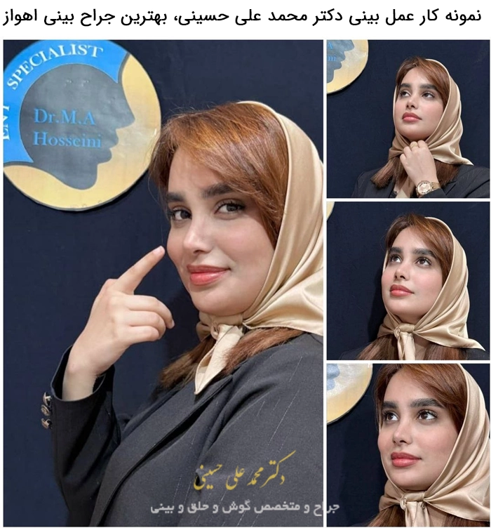 نمونه کار عمل بینی توسط بهترین جراح بینی اهواز