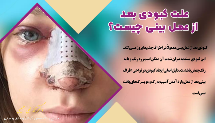علت کبودی بعد از عمل بینی