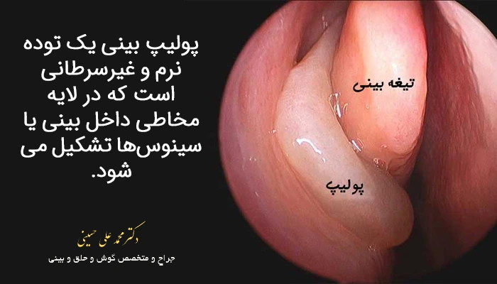 پولیپ بینی چیست
