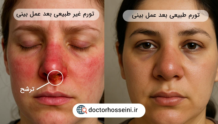 تورم طبیعی و غیر طبیعی بعد از عمل بینی