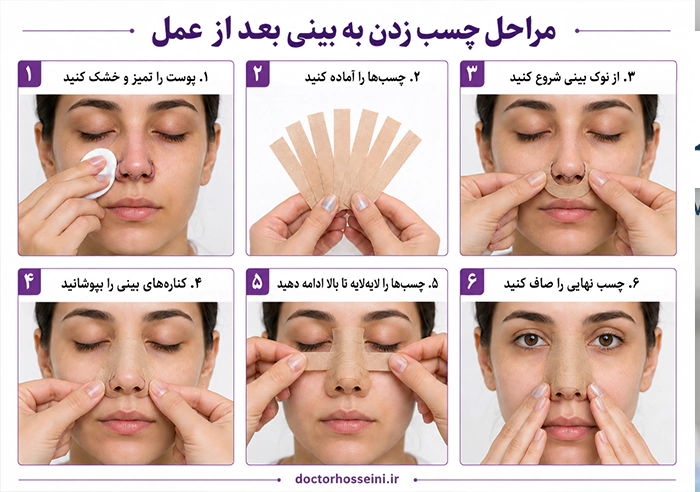 مراحل چسب زدن به بینی بعد از عمل