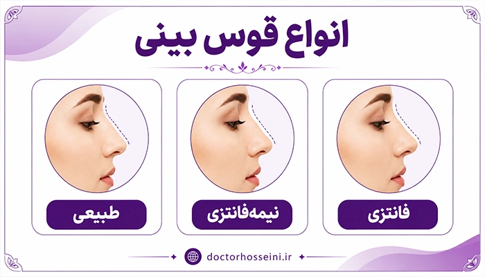 انواع قوس بینی